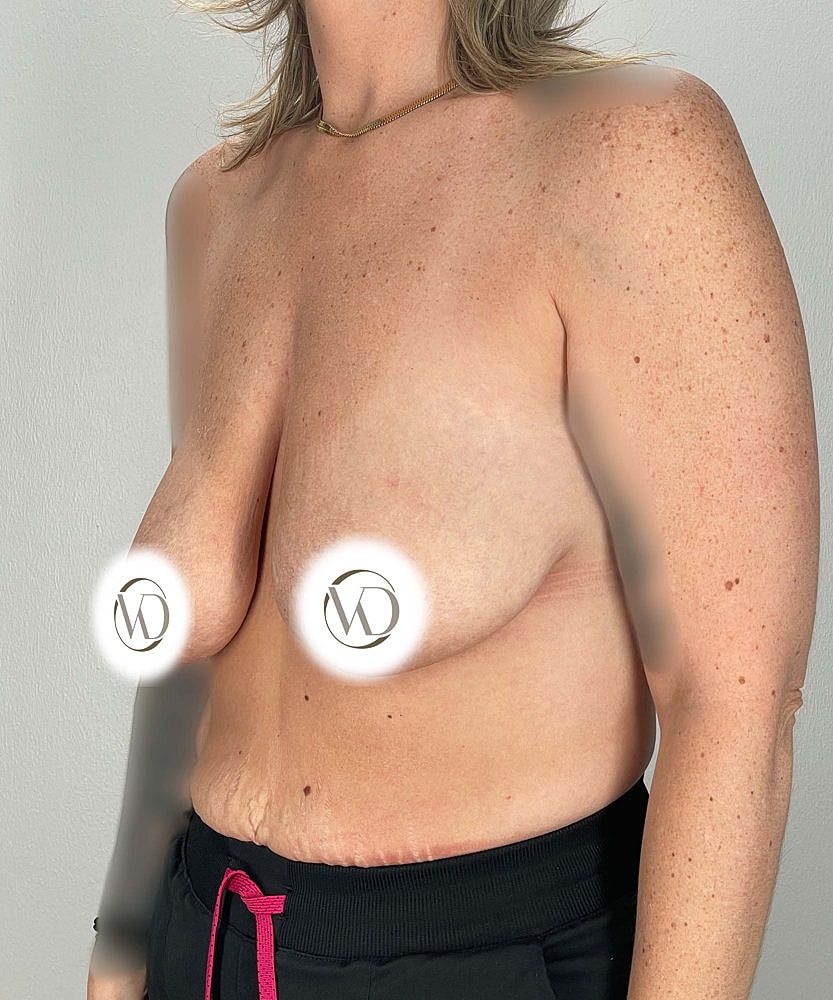Breast Lift Implants Before & After