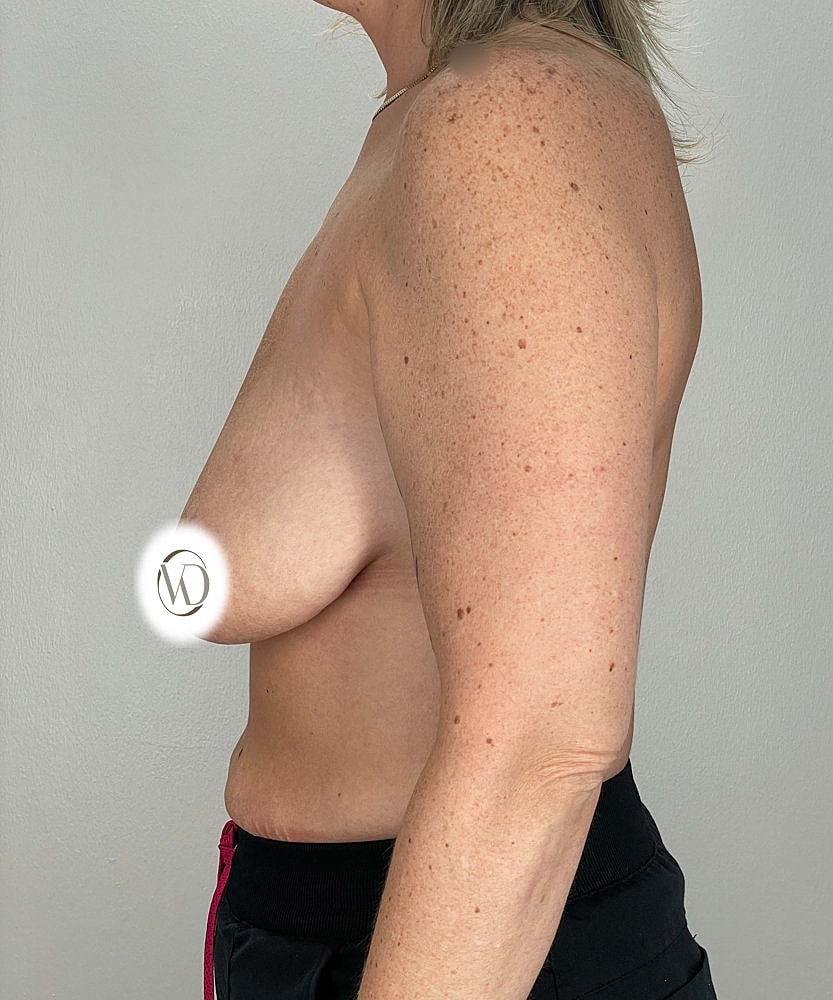 Breast Lift Implants Before & After