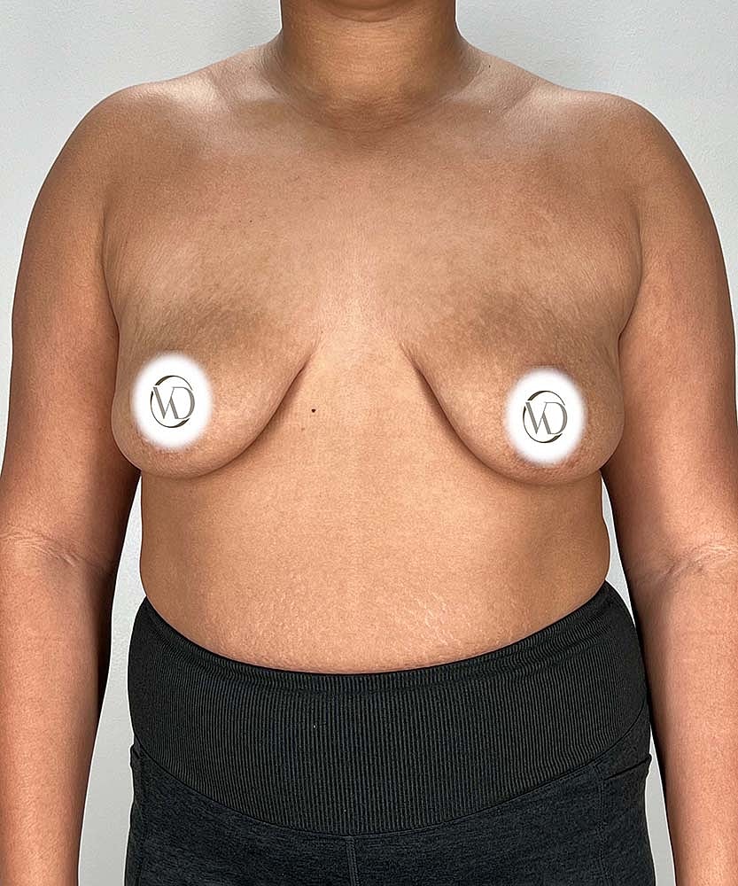 Breast Lift Implants Before & After
