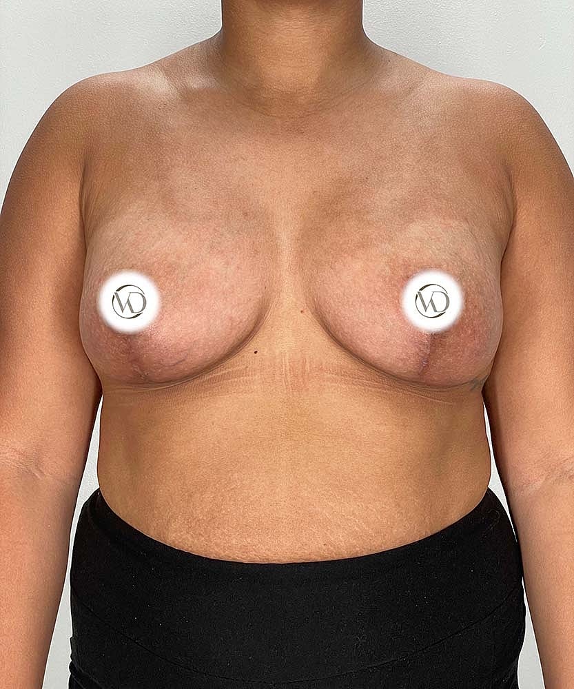Breast Lift Implants Before & After