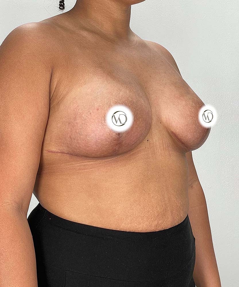 Breast Lift Implants Before & After