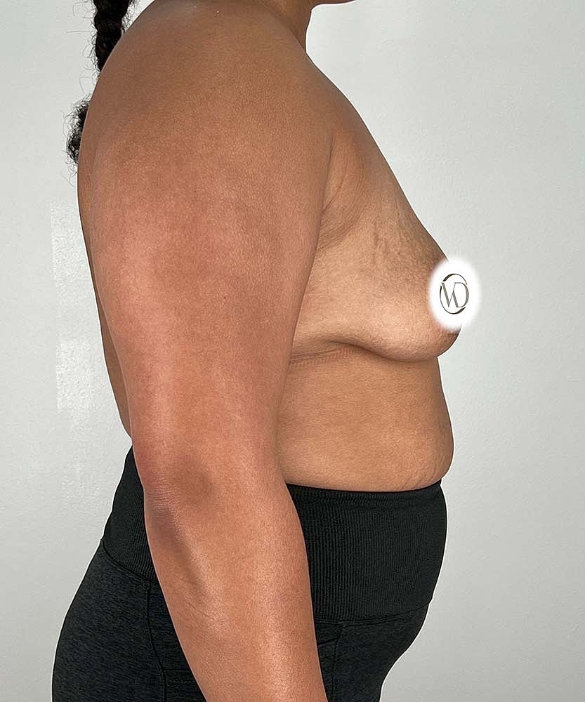 Breast Lift Implants Before & After