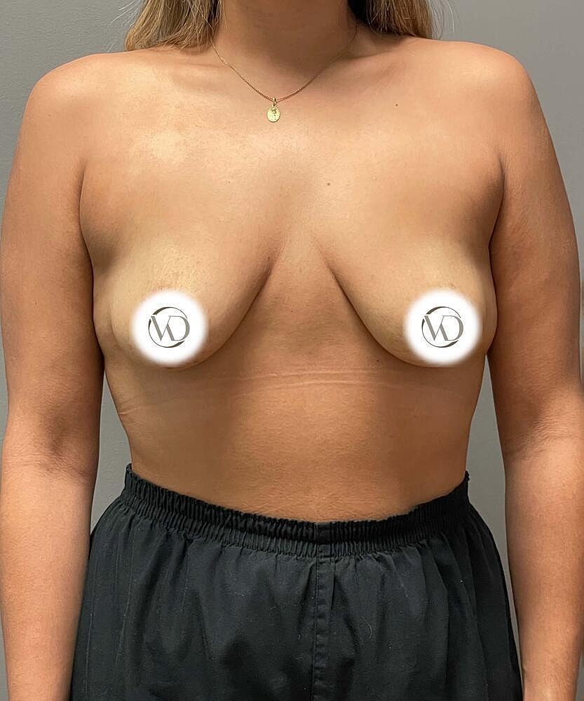 Breast Lift Implants Before & After