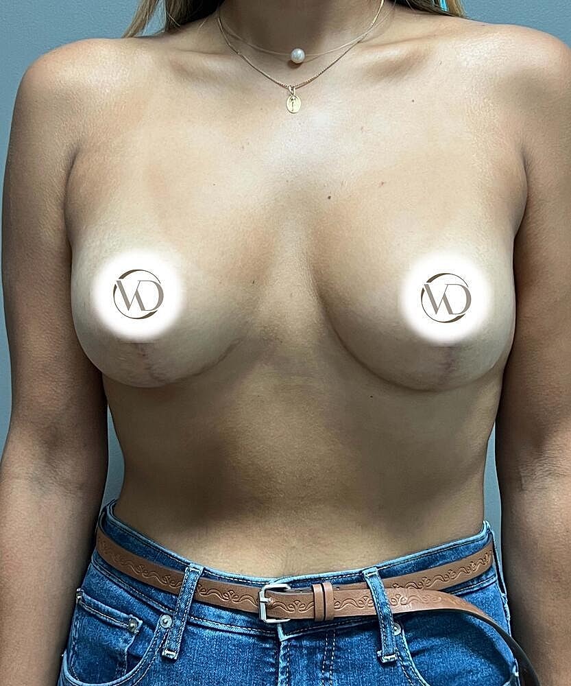 Breast Lift Implants Before & After