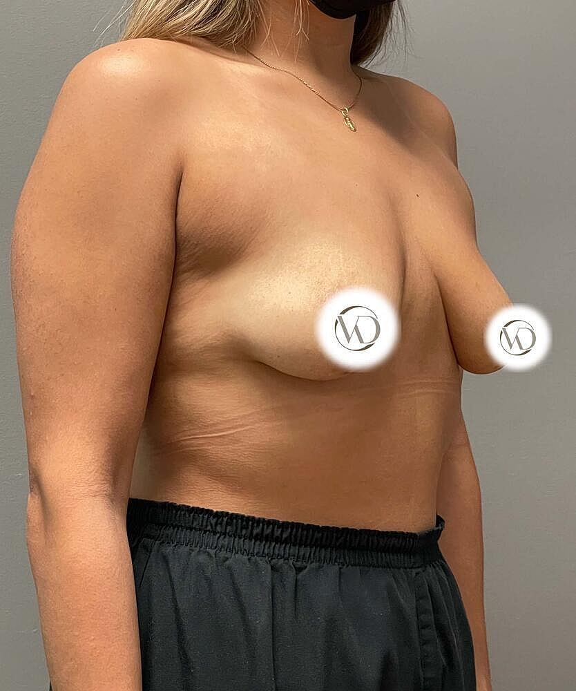 Breast Lift Implants Before & After