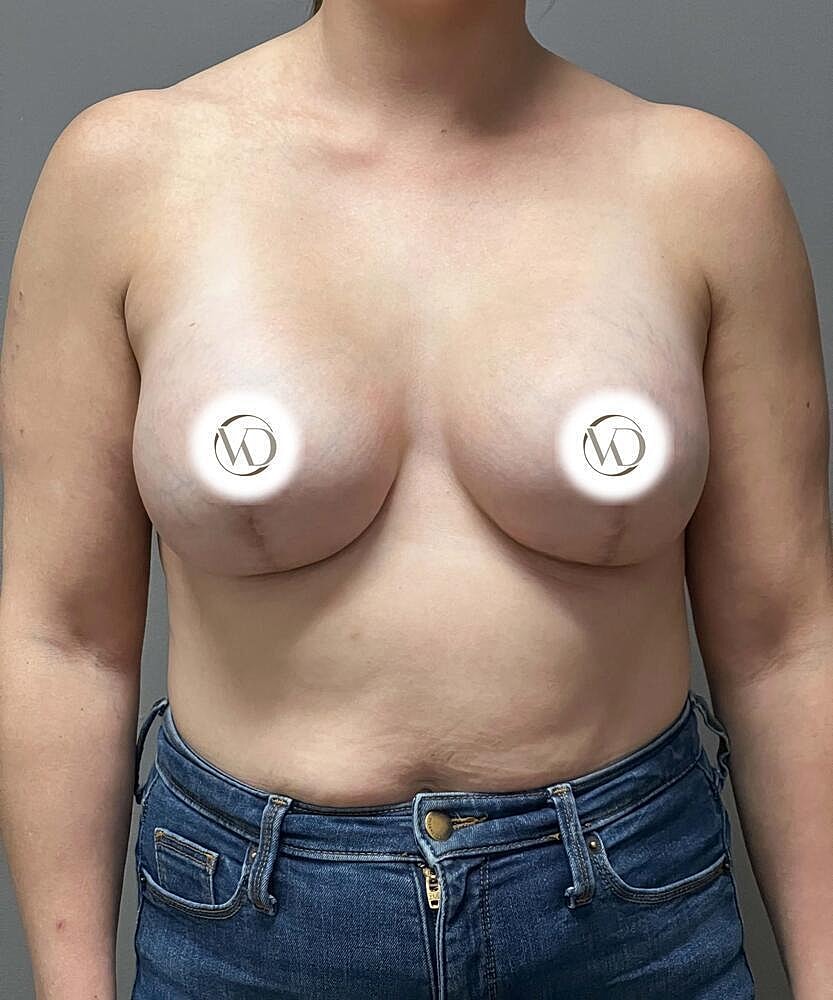 Breast Lift Implants Before & After