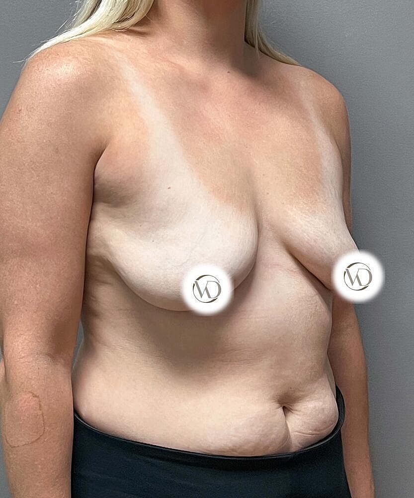 Breast Lift Implants Before & After