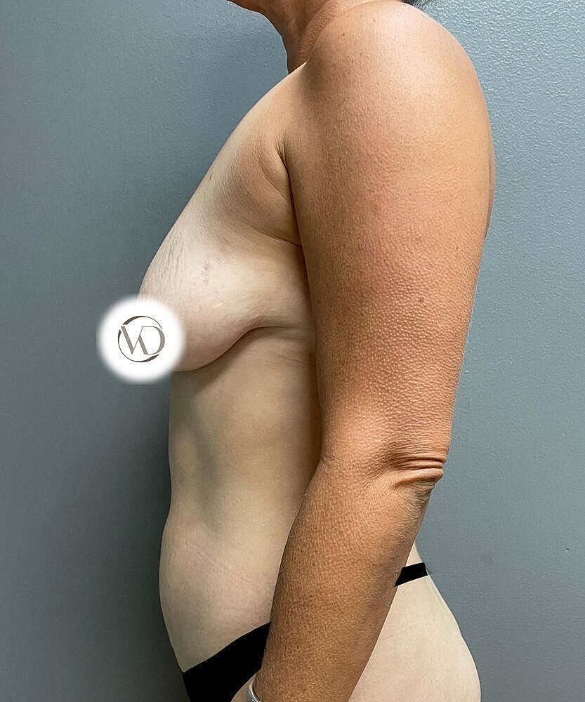 Breast Lift Implants Before & After
