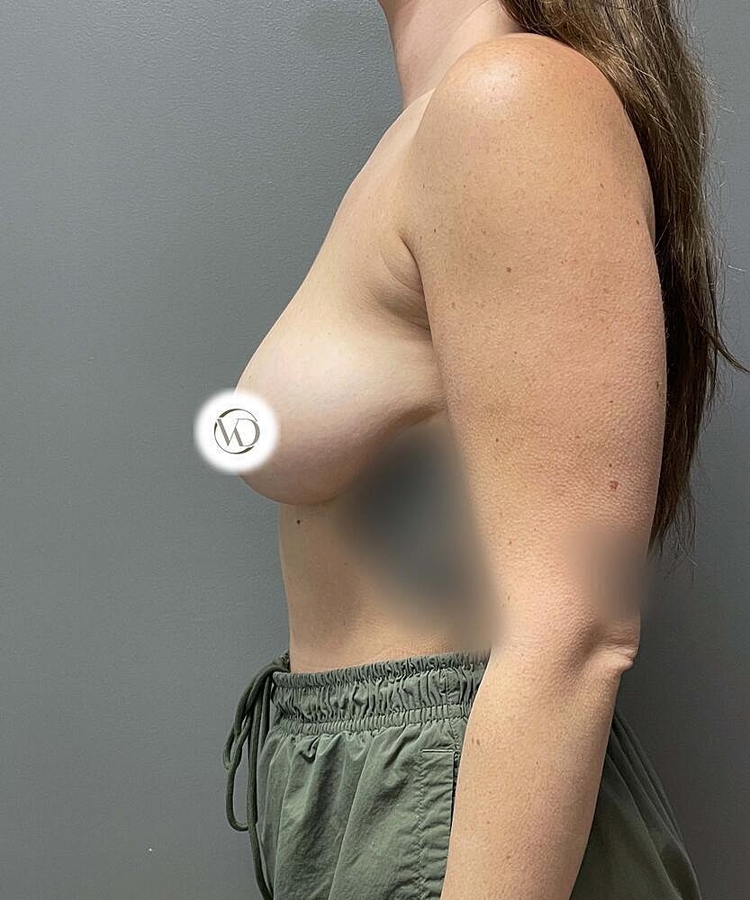 Breast Lift Implants Before & After