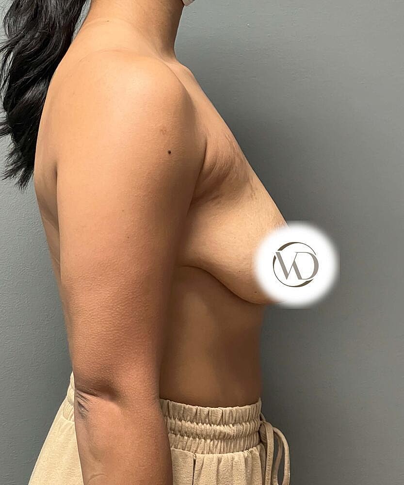 Breast Lift Implants Before & After