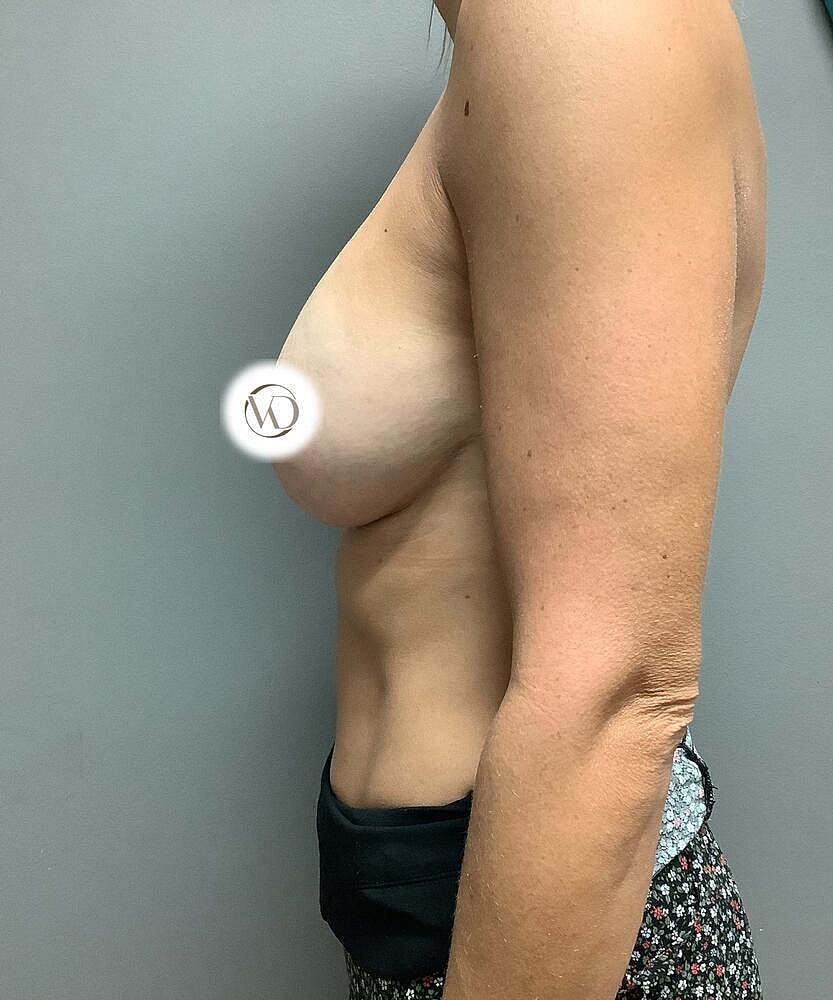 Breast Lift Implants Before & After