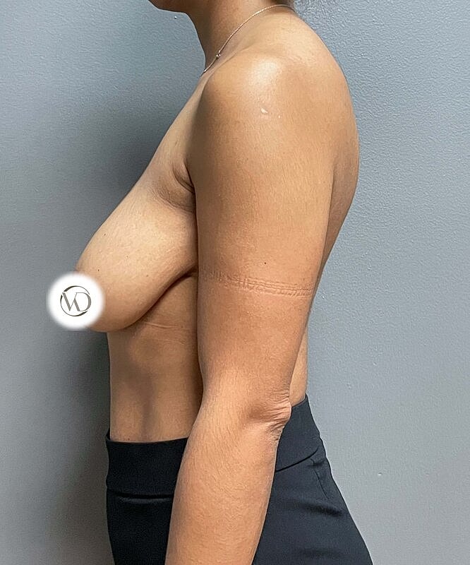 Breast Lift Implants Before & After