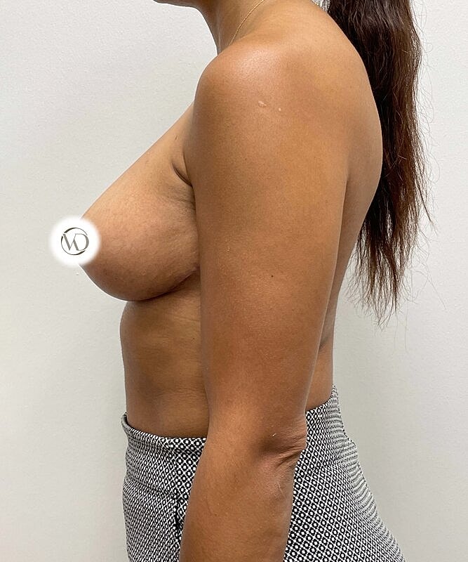 Breast Lift Implants Before & After