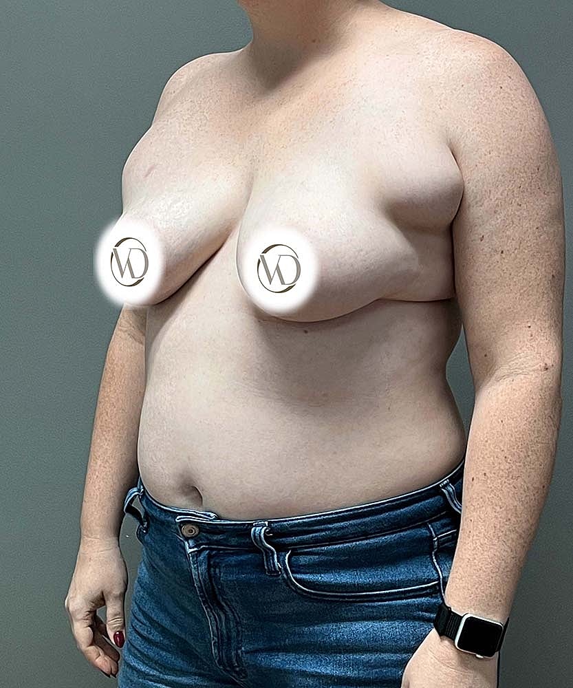 Breast Lift Implants Before & After