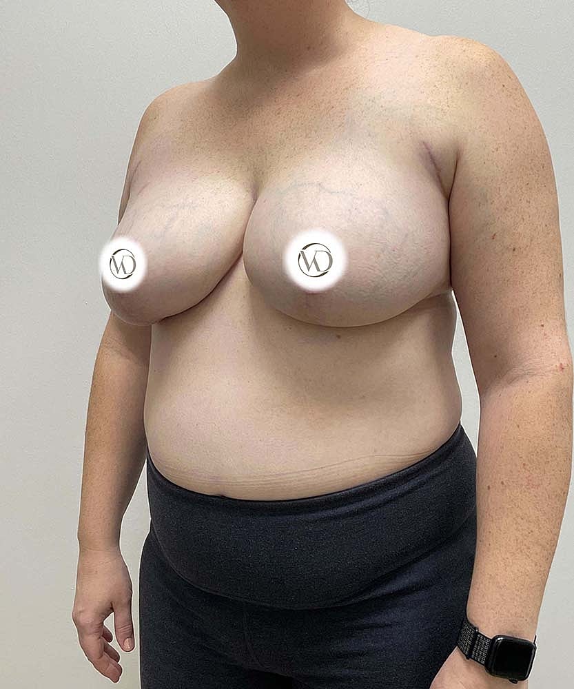Breast Lift Implants Before & After