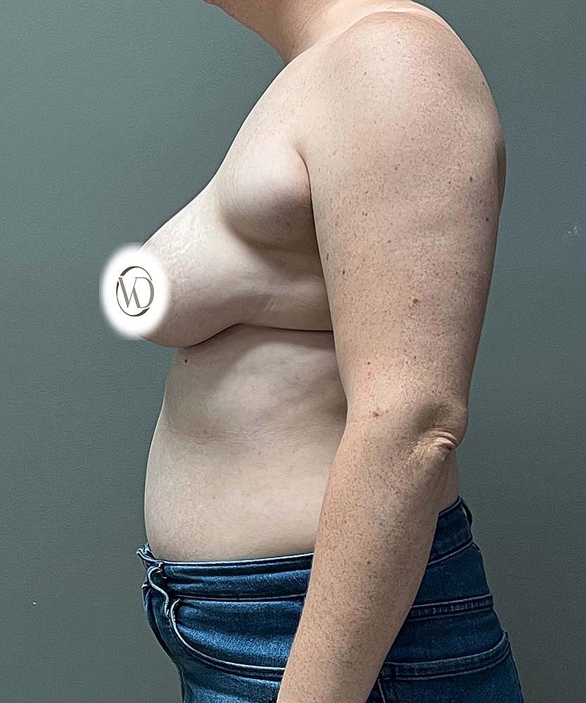 Breast Lift Implants Before & After