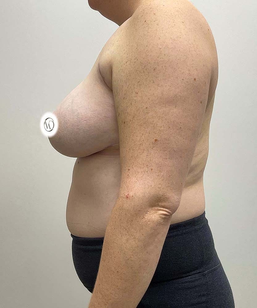 Breast Lift Implants Before & After