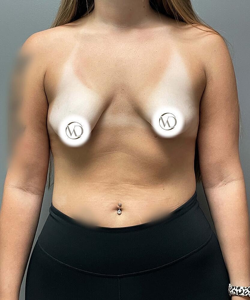 Breast Lift Implants Before & After