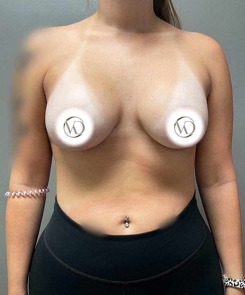 Breast Lift Implants Before & After