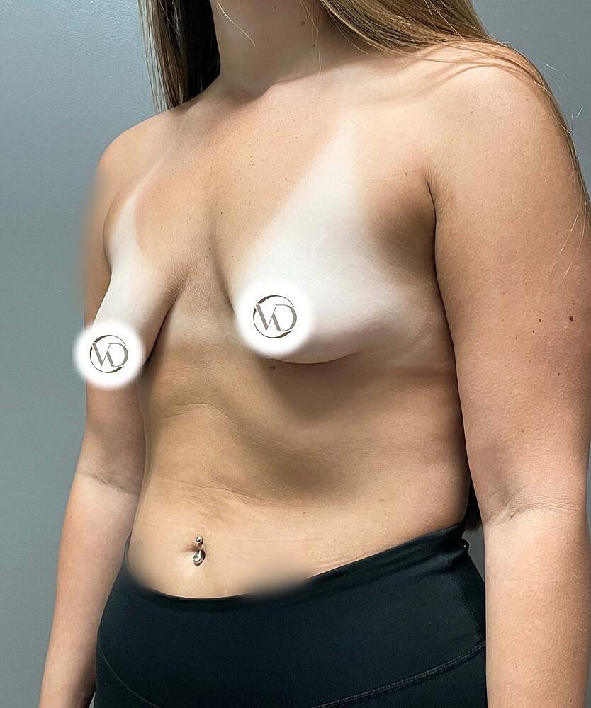 Breast Lift Implants Before & After