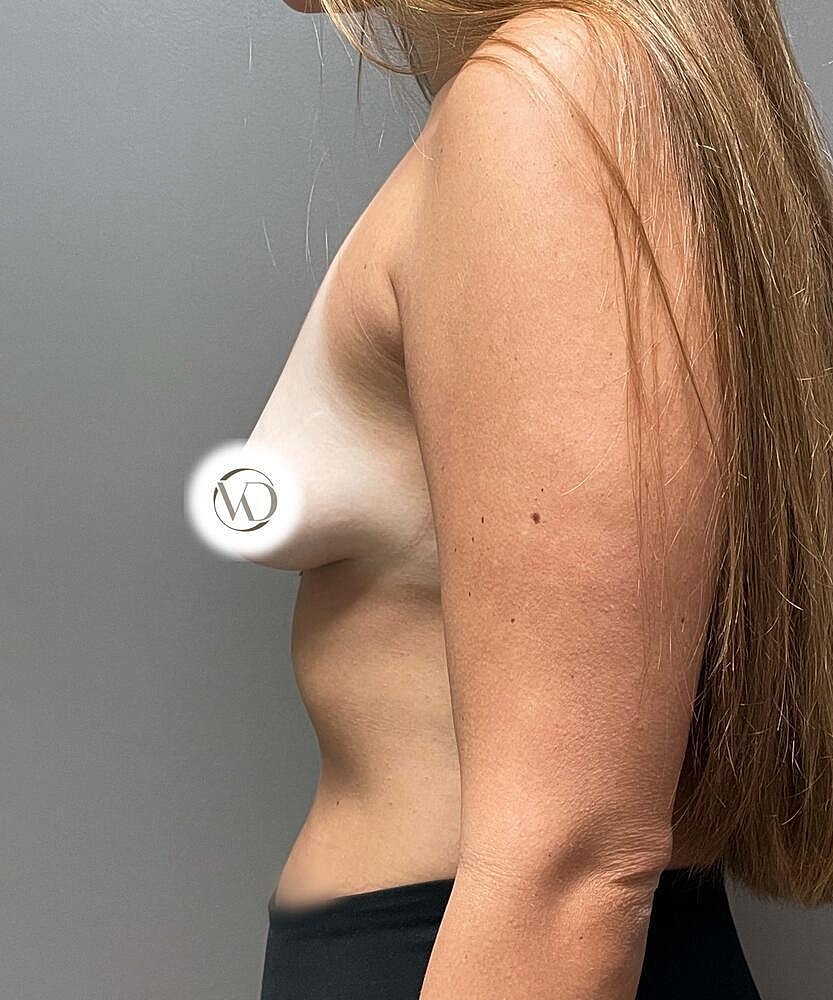 Breast Lift Implants Before & After