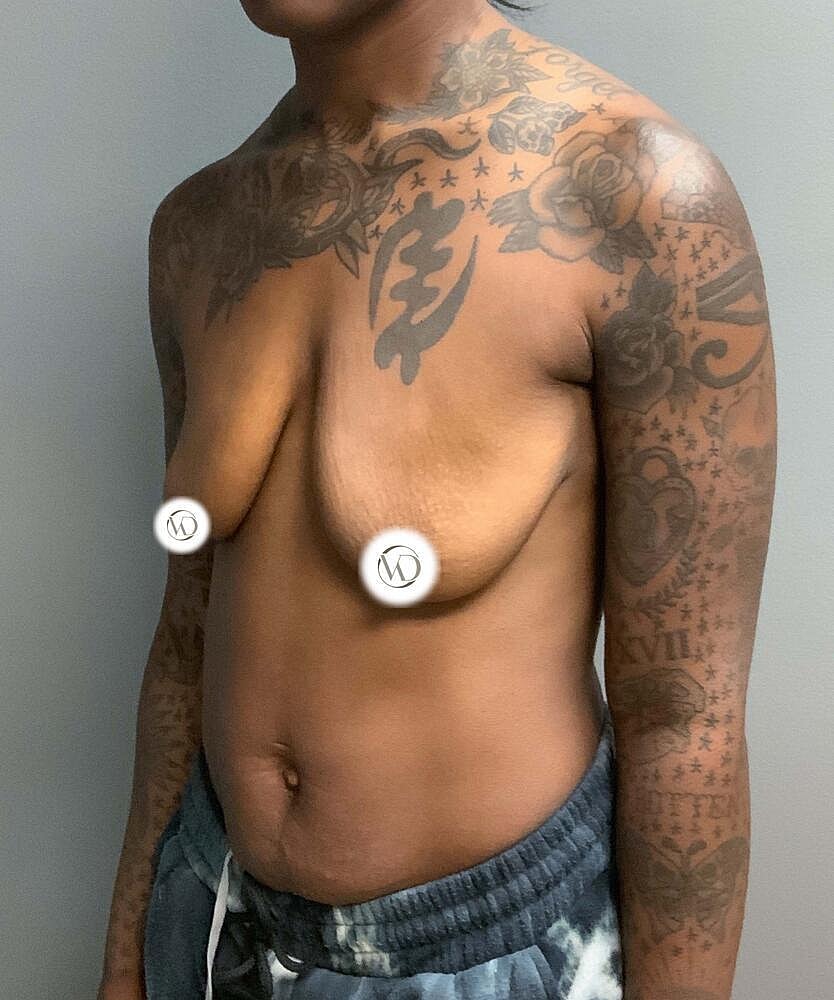 Breast Lift Implants Before & After