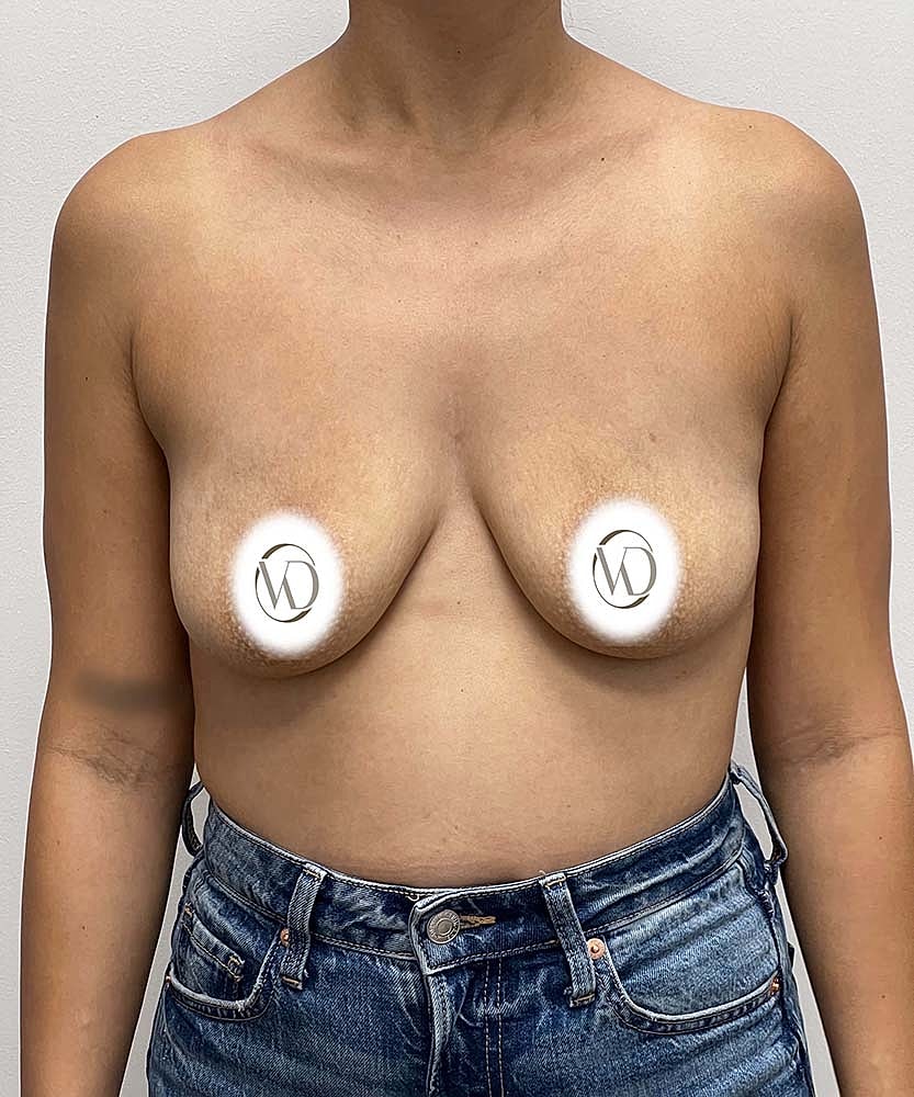Breast Lift Implants Before & After