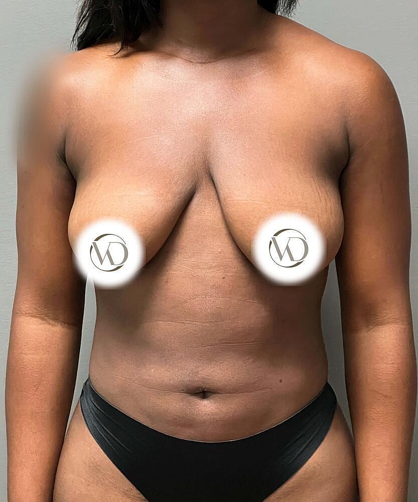 Breast Lift Implants Before & After