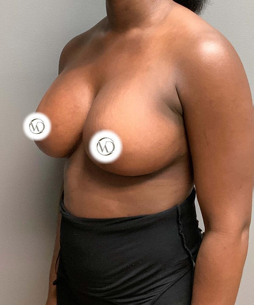 Breast Lift Implants Before & After