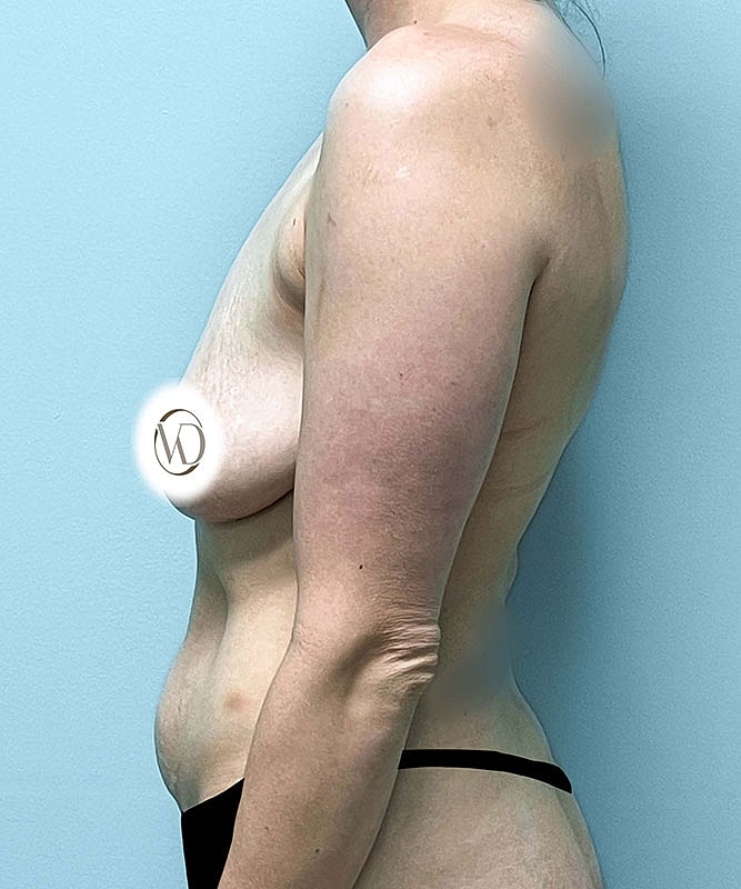 Breast Lift Implants Before & After