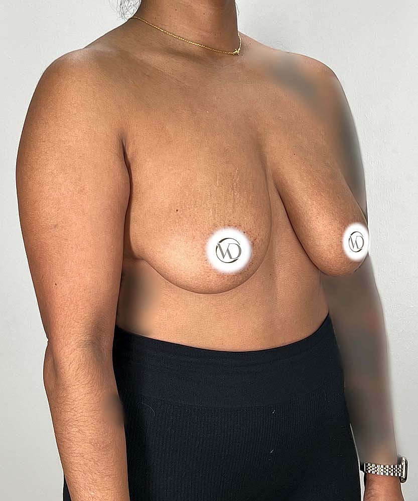 Breast Lift Implants Before & After
