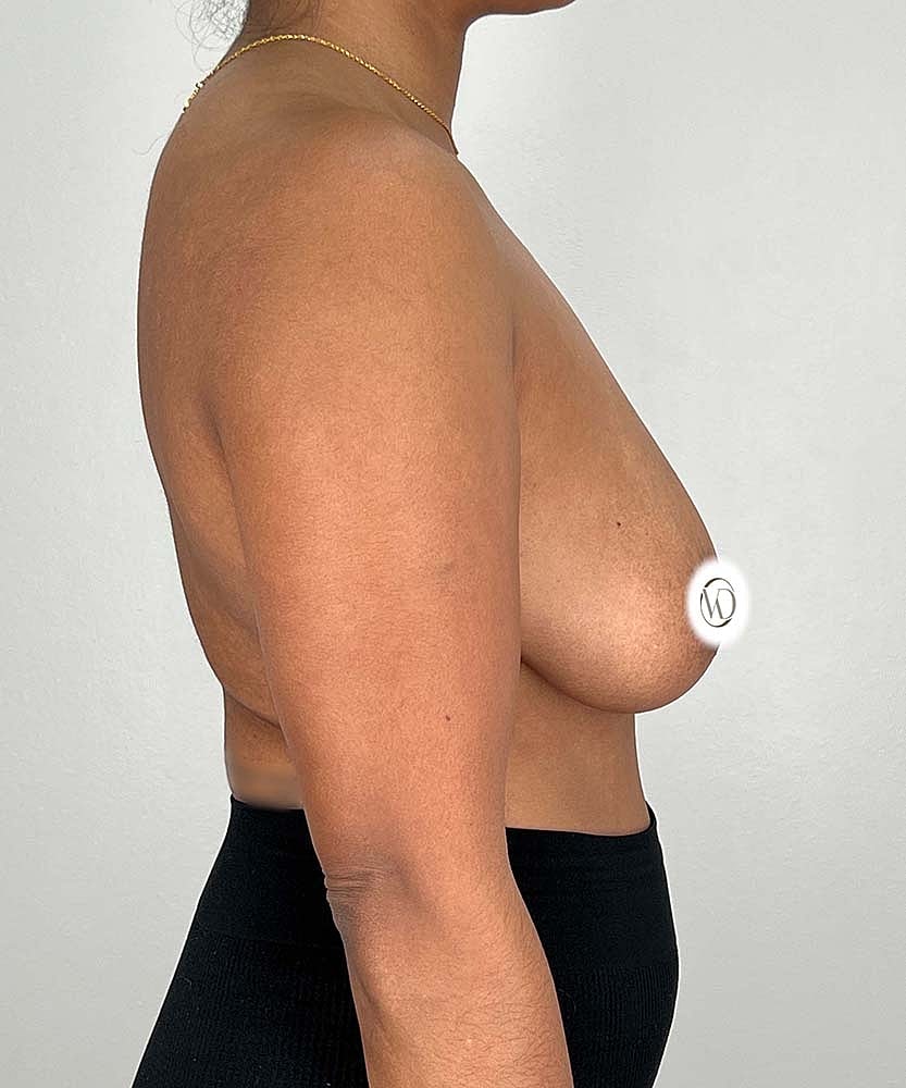 Breast Lift Implants Before & After