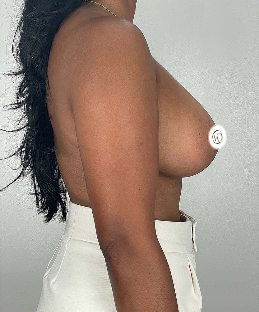 Breast Lift Implants Before & After