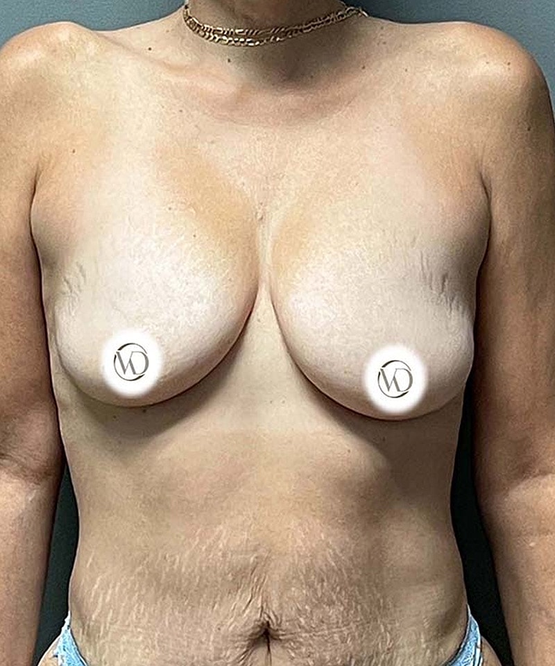 Breast Lift Implants Before & After