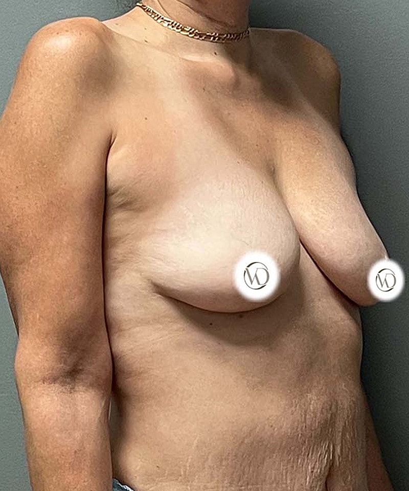 Breast Lift Implants Before & After