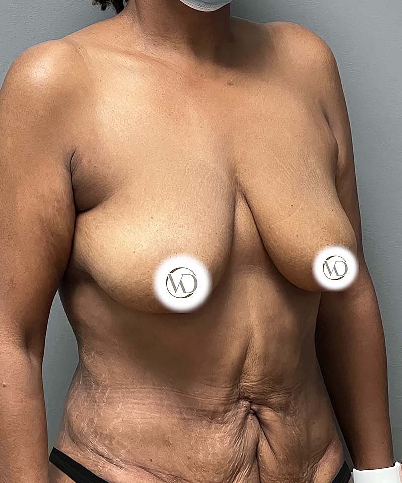 Breast Lift Implants Before & After