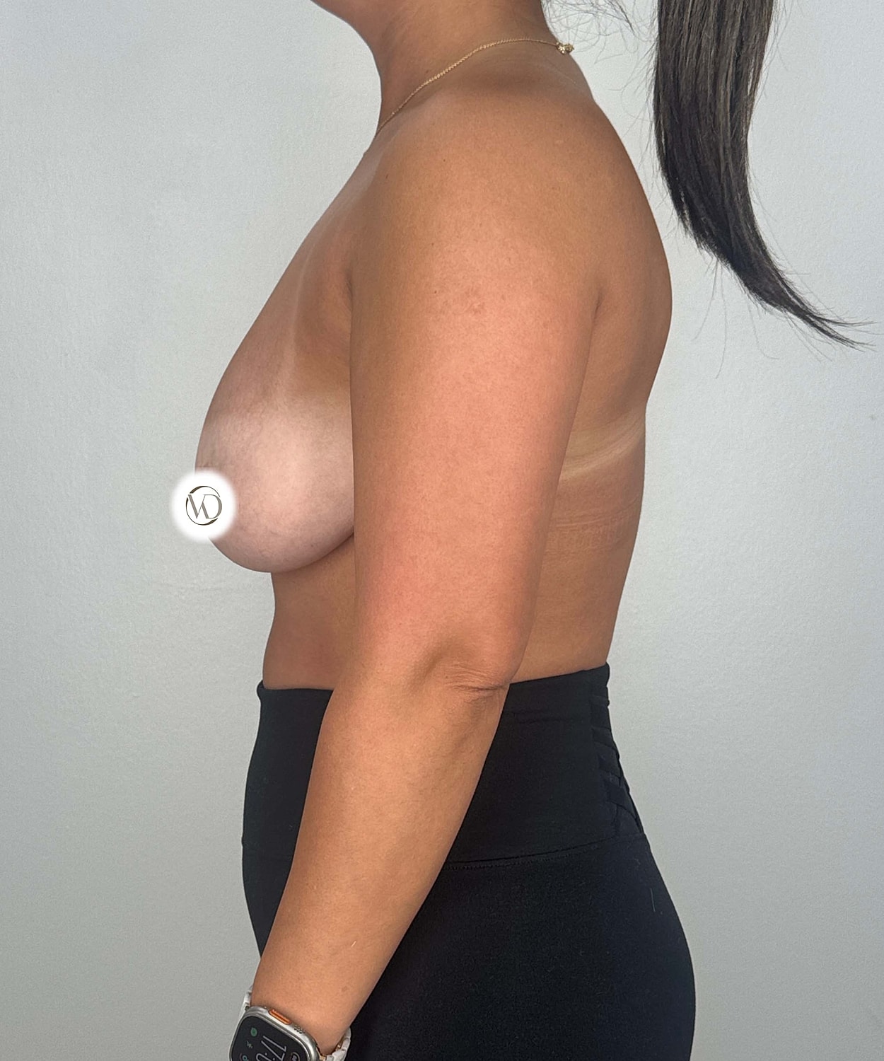 Breast Lift With Implants Gallery Before & After