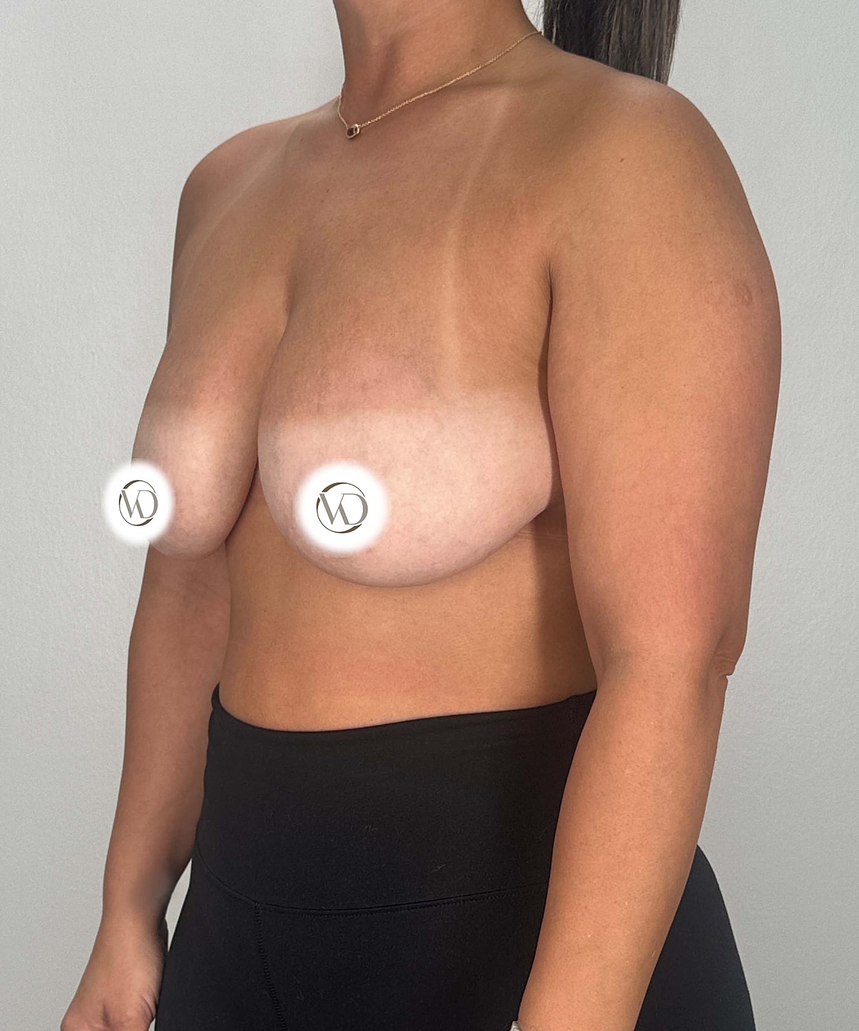 Breast Lift With Implants Gallery Before & After