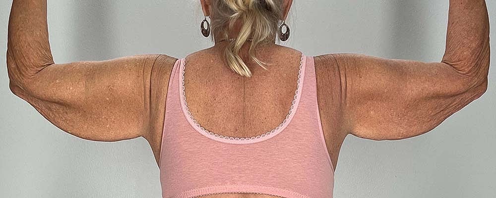 Arm Lift Before & After