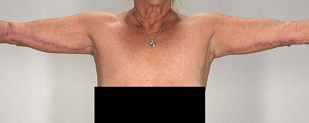 Arm Lift Before & After