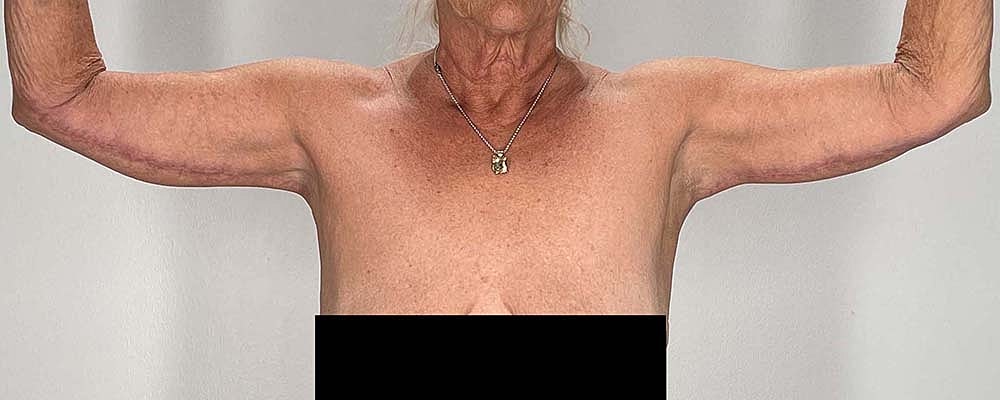 Arm Lift Before & After