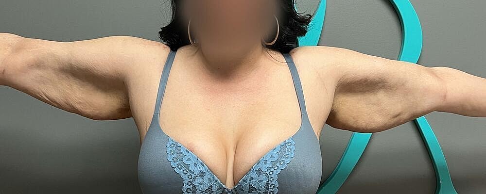 Arm Lift Before & After