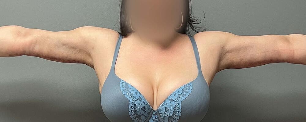 Arm Lift Before & After