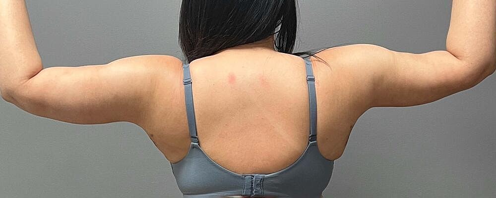 Arm Lift Before & After