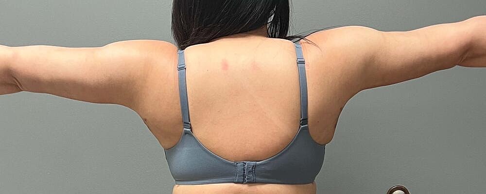 Arm Lift Before & After