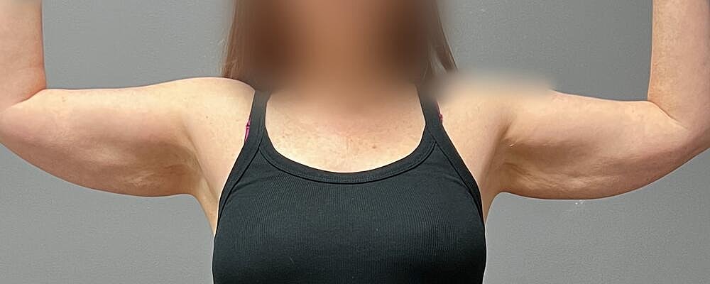 Arm Lift Before & After