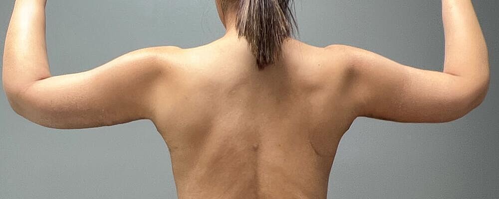 Arm Lift Before & After