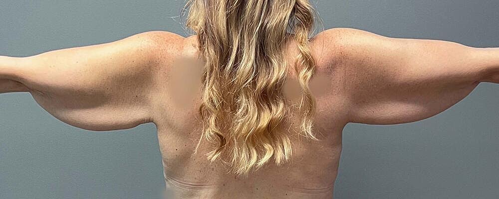 Arm Lift Before & After