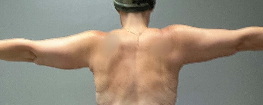 Arm Lift Before & After