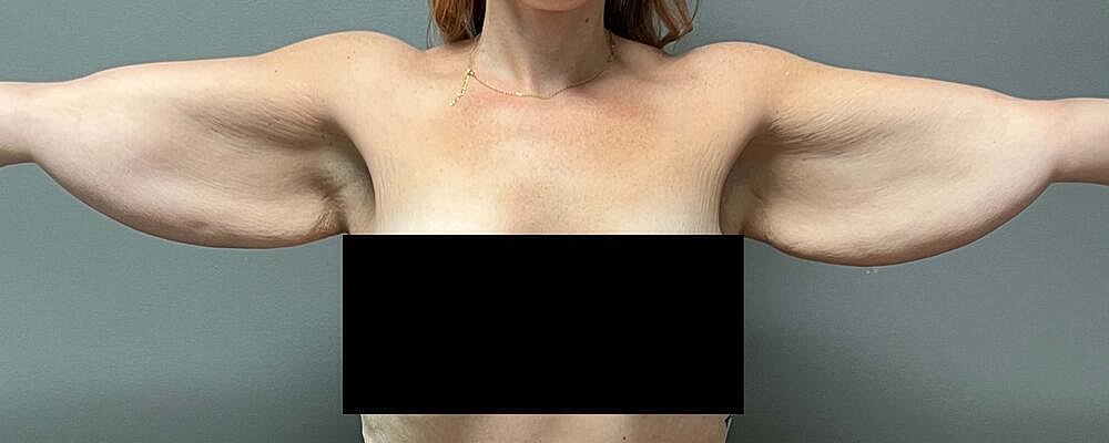 Arm Lift Before & After